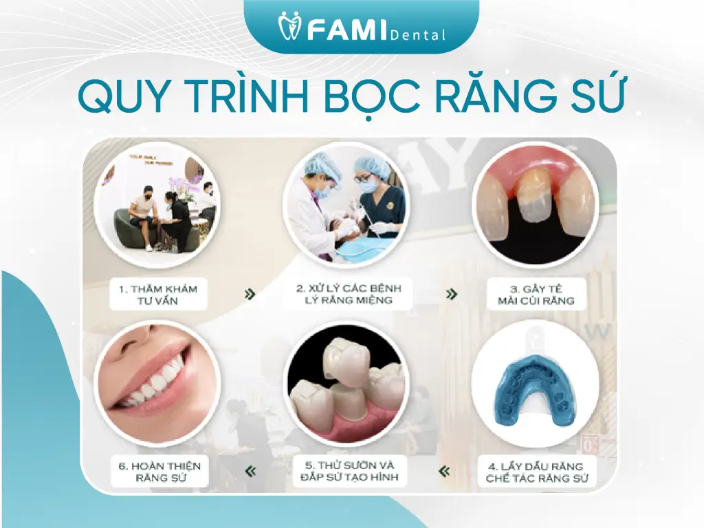 Quy trình bọc răng sứ mới nhất 2025 1 Các bước bọc răng sứ