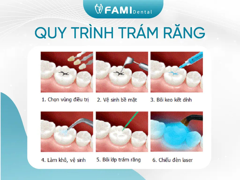 Quy trình trám răng mới nhất 2025 1 Các bước trám răng