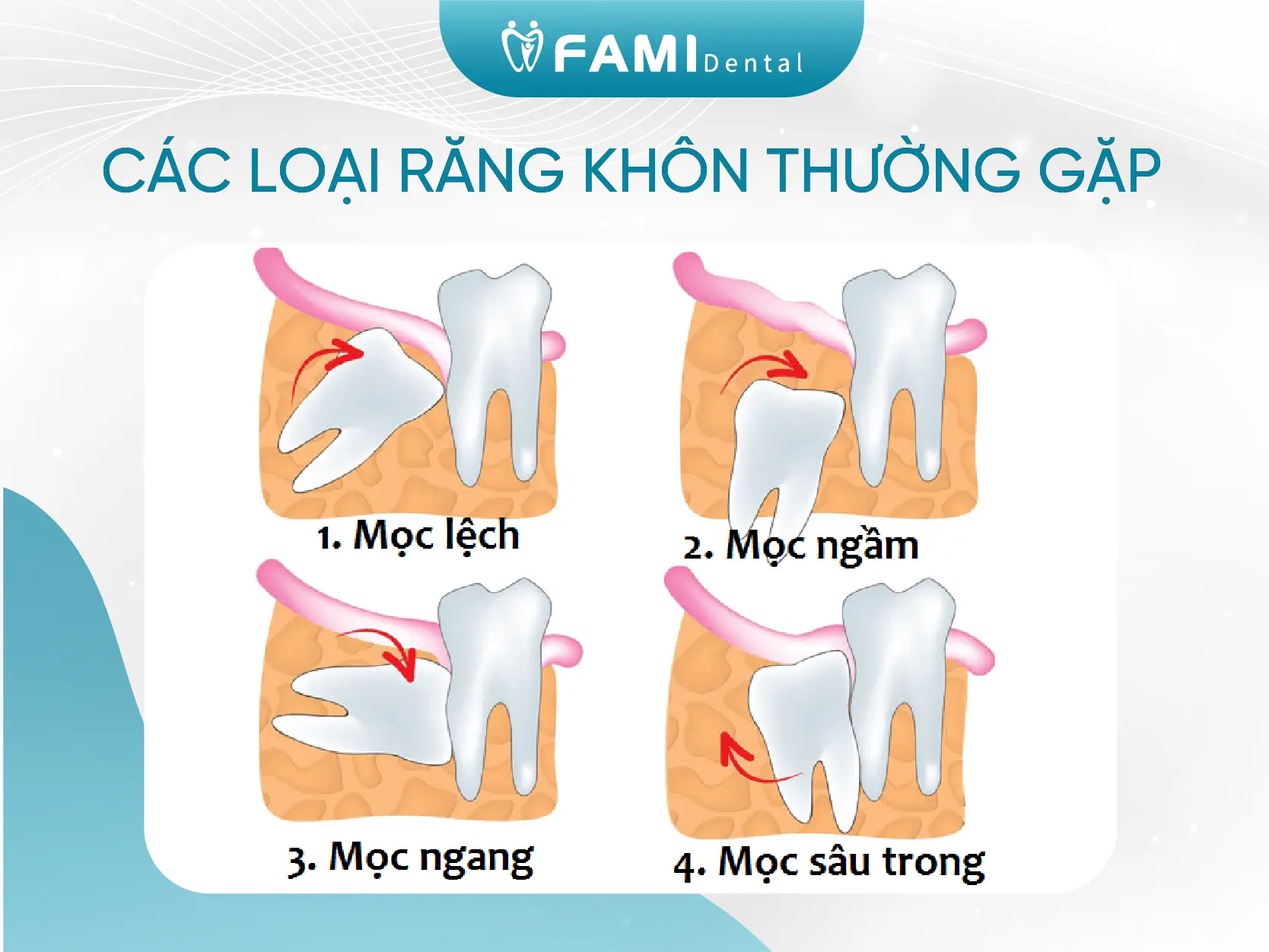 Các loại răng khôn