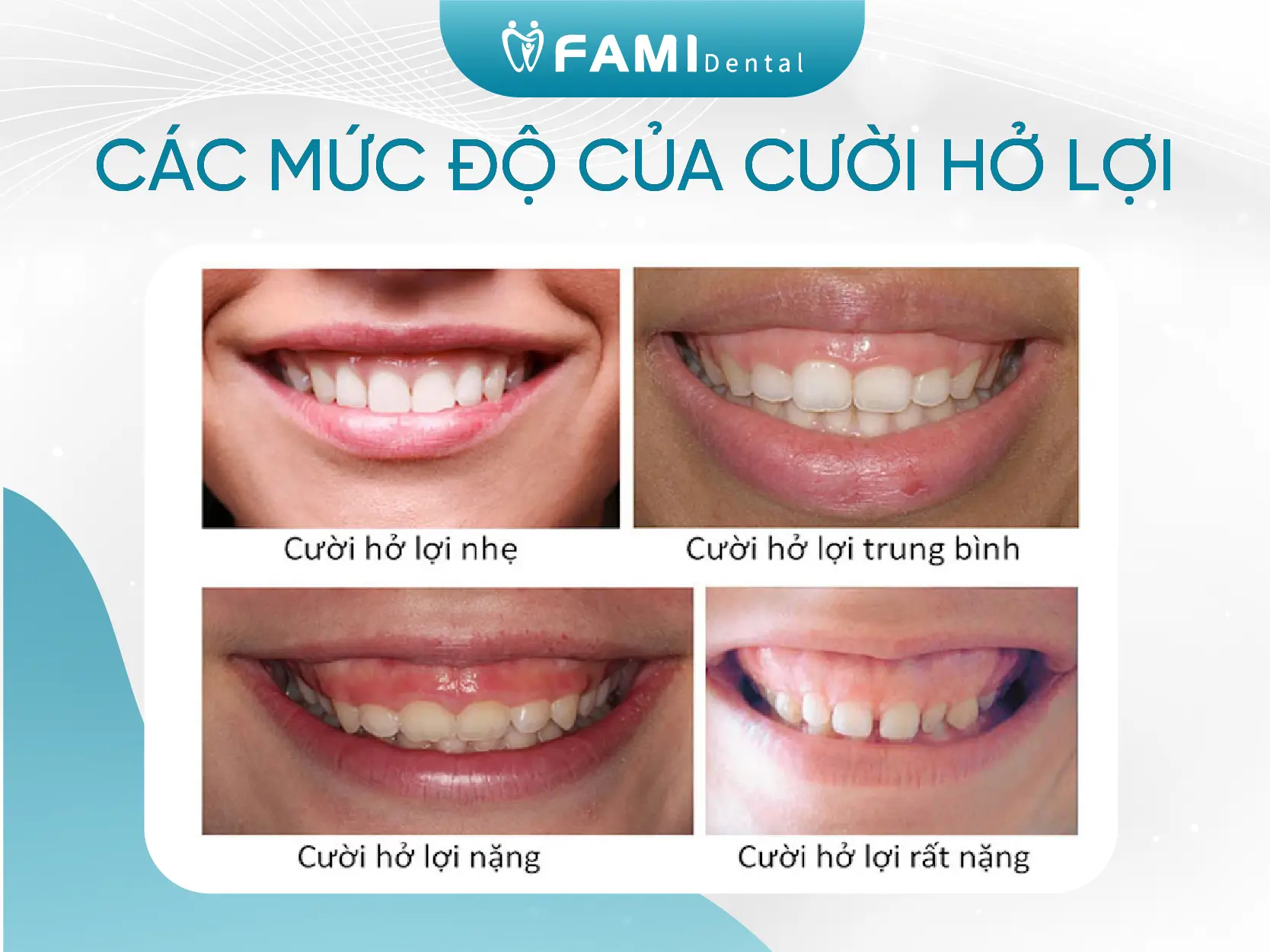 4 mức độ cười hở lợi mà các bạn cần biết 1 Các mức độ cười hở lợi