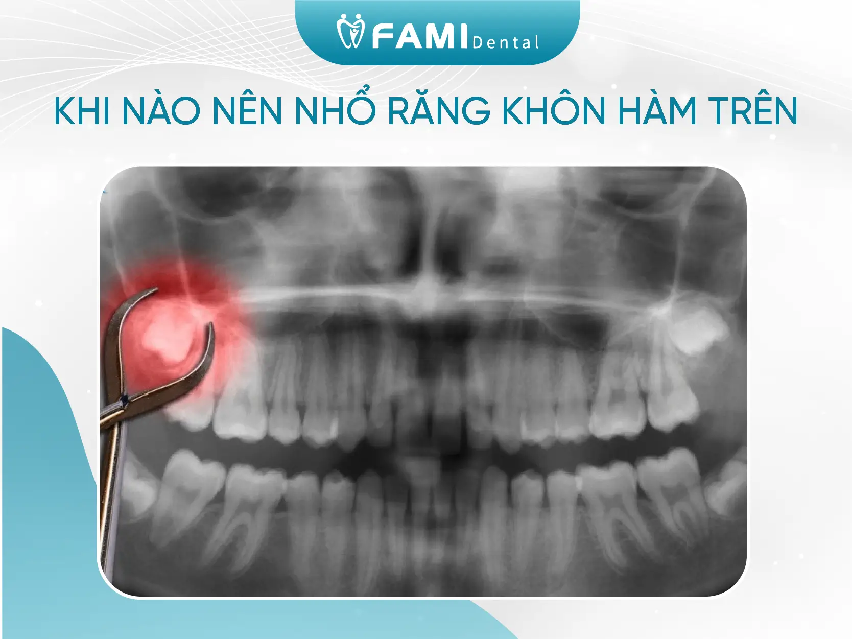 lưu ý khi nhổ răng khôn hàm trên