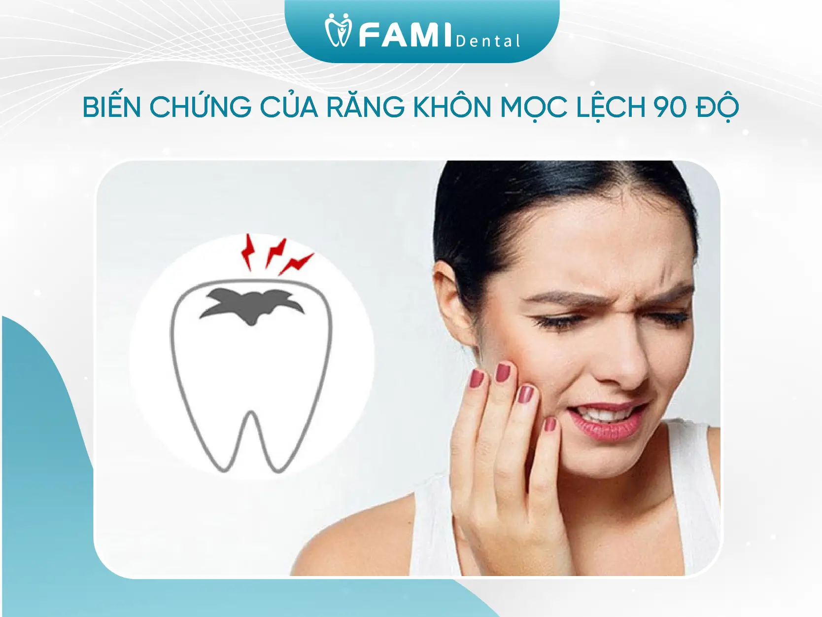 Răng khôn mọc lệch 90 độ và những điều cần lưu ý khi nhổ 1 hững biến chứng của răng khôn mọc lệch 90 độ