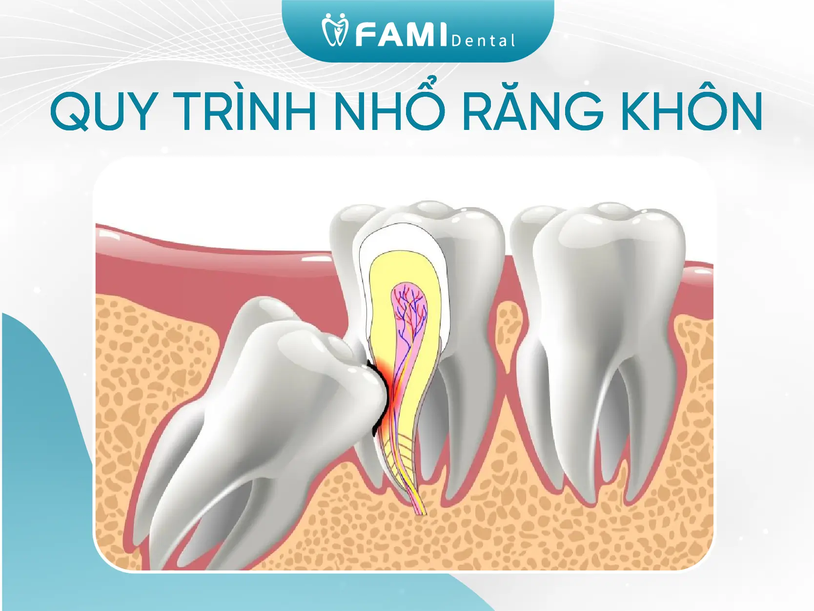 Quy trình nhổ răng khôn