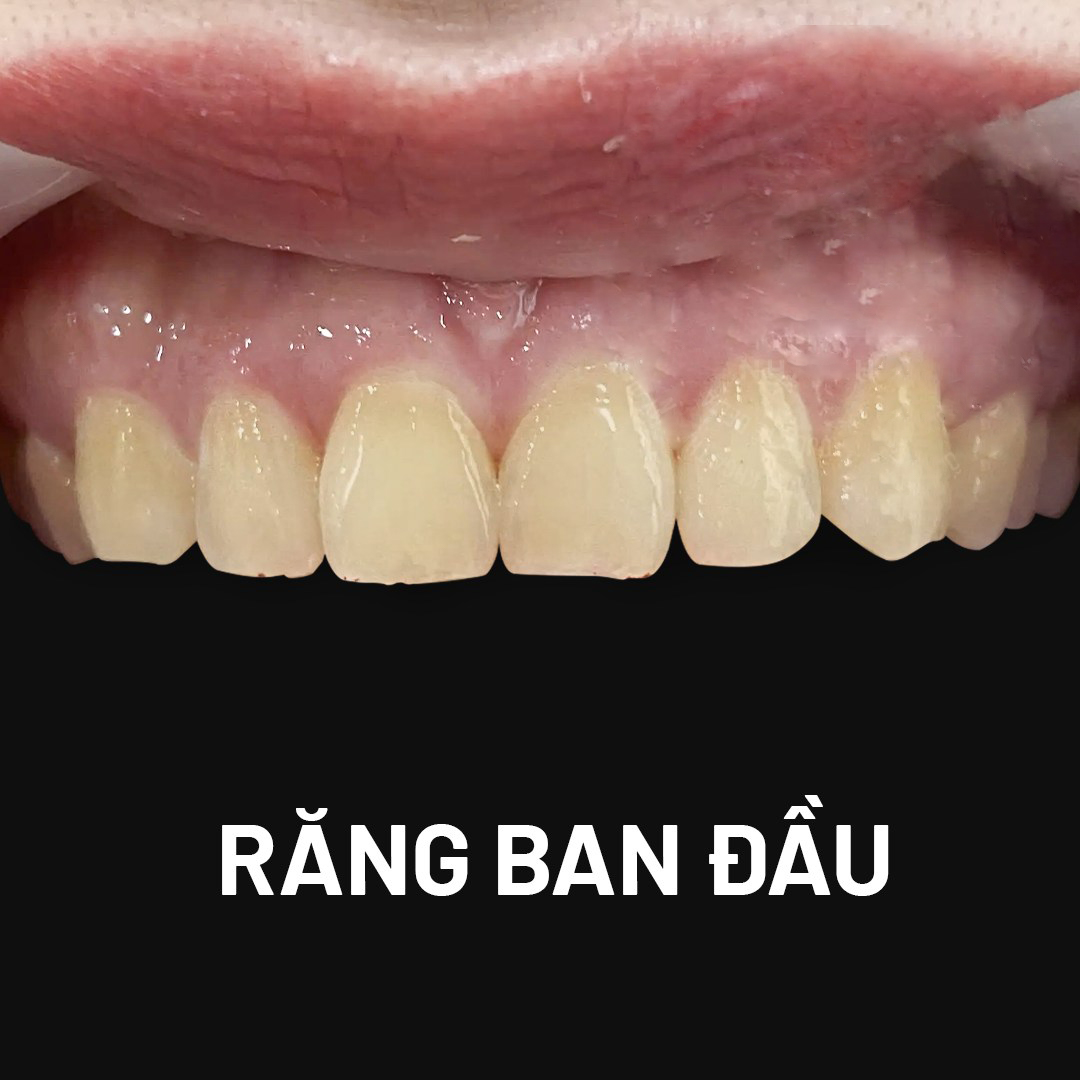 Ưu đãi răng sứ - Nhận mã giảm giá 20% Rang Theo Giai Doan Mai Ban Dau