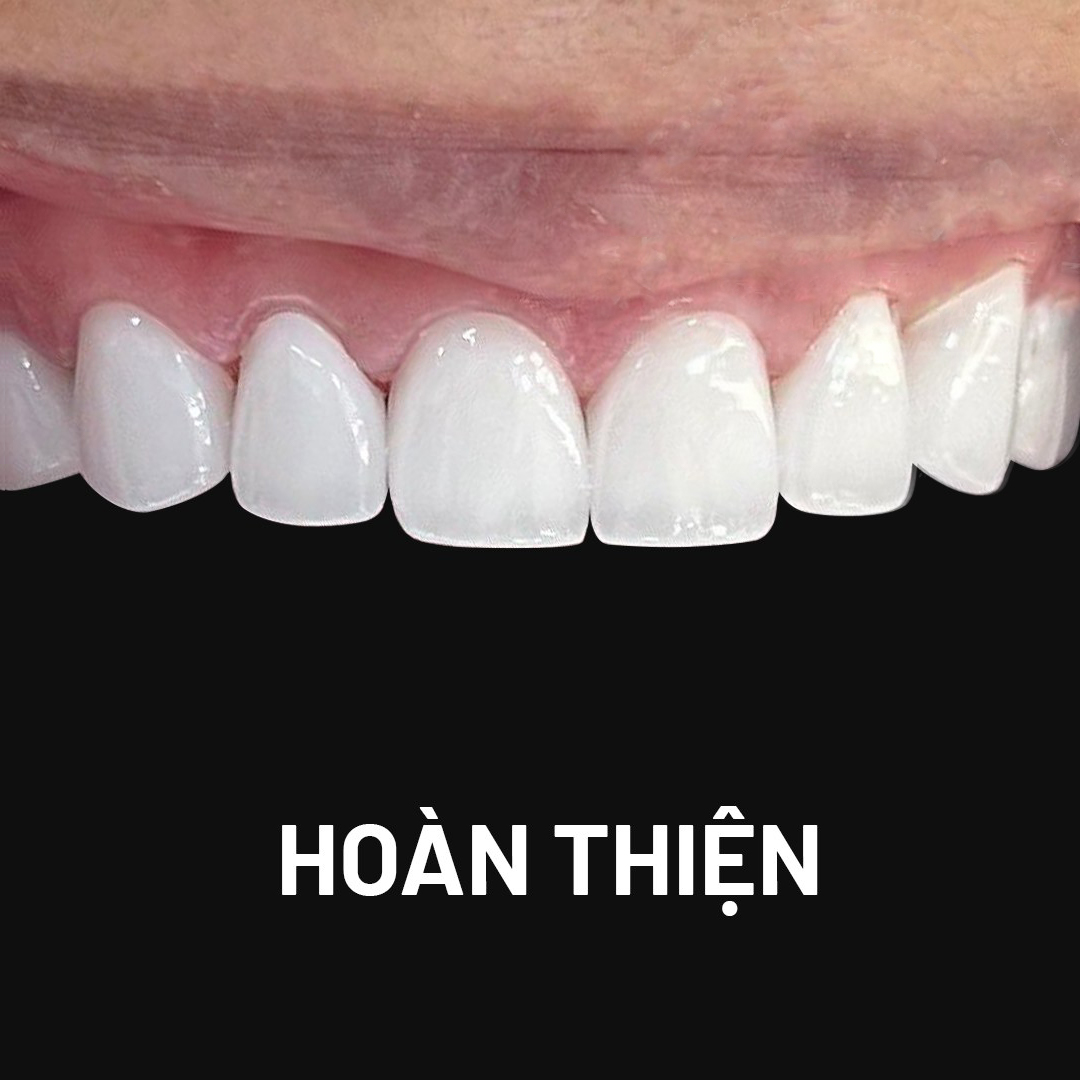 Ưu đãi răng sứ - Nhận mã giảm giá 20% Rang Theo Giai Doan Mai Hoan Thien