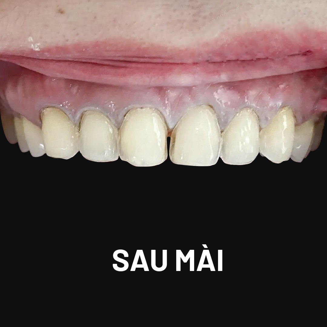 Ưu đãi răng sứ - Nhận mã giảm giá 20% Rang Theo Giai Doan Mai Sau Mai