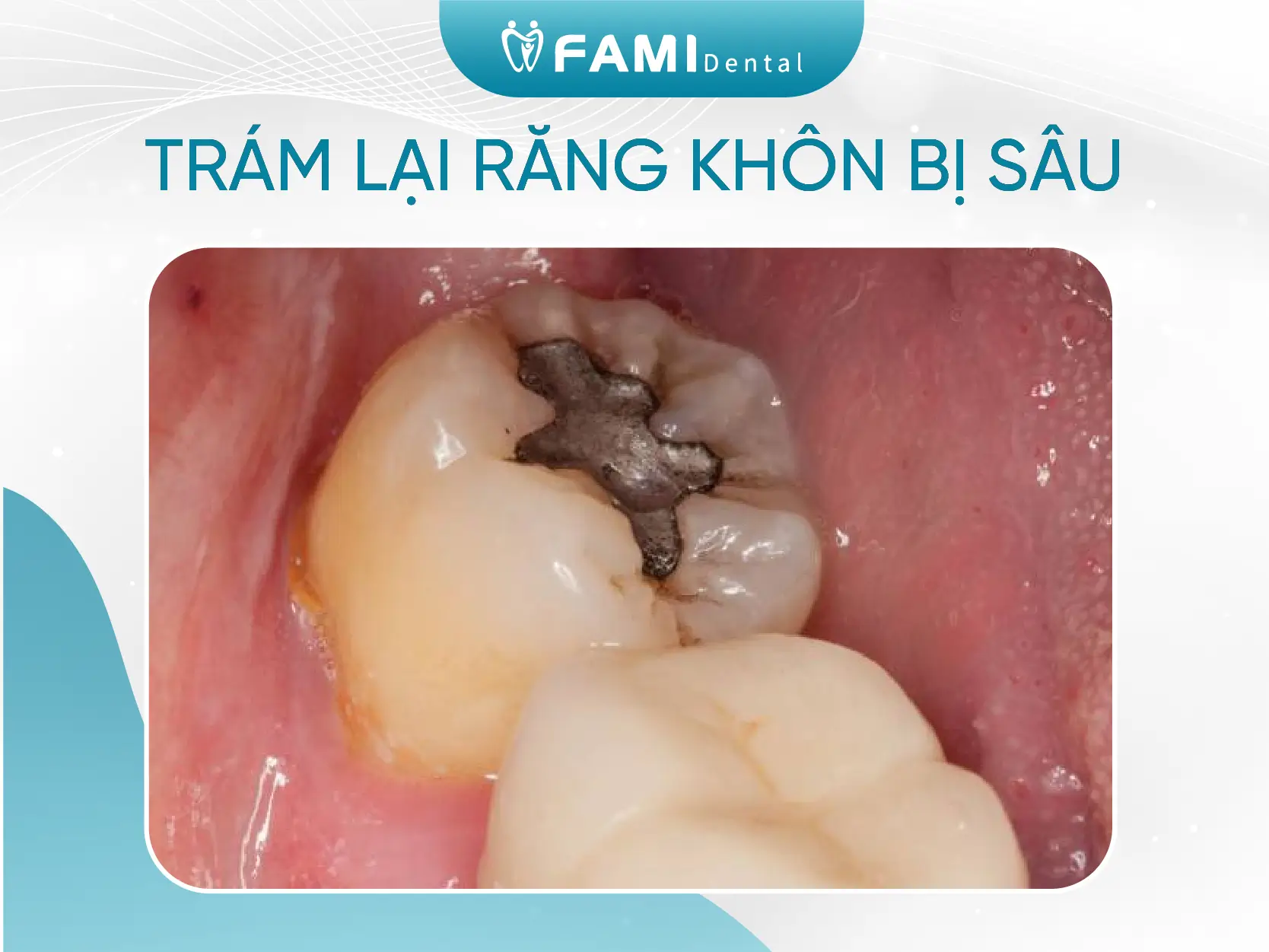 Trám lại răng khôn bị sâu