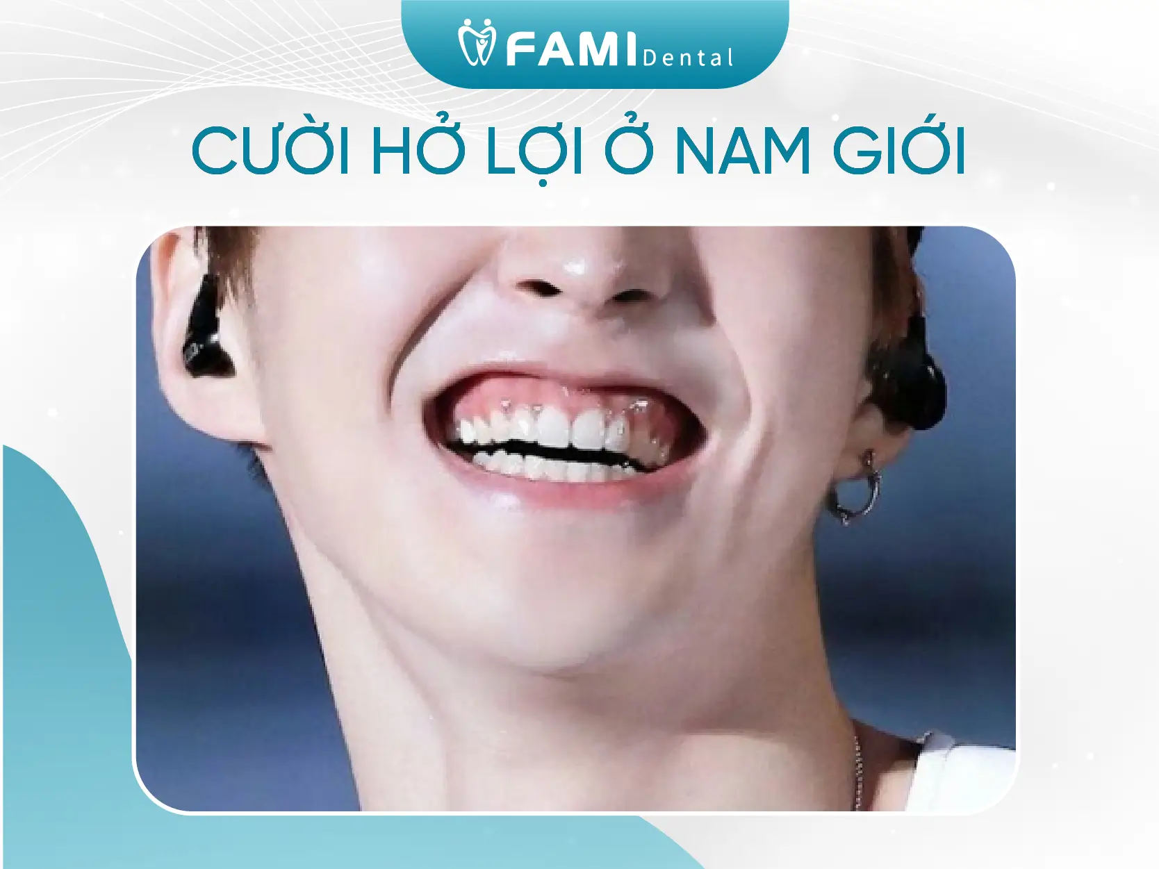 cười hở lợi ở nam giới