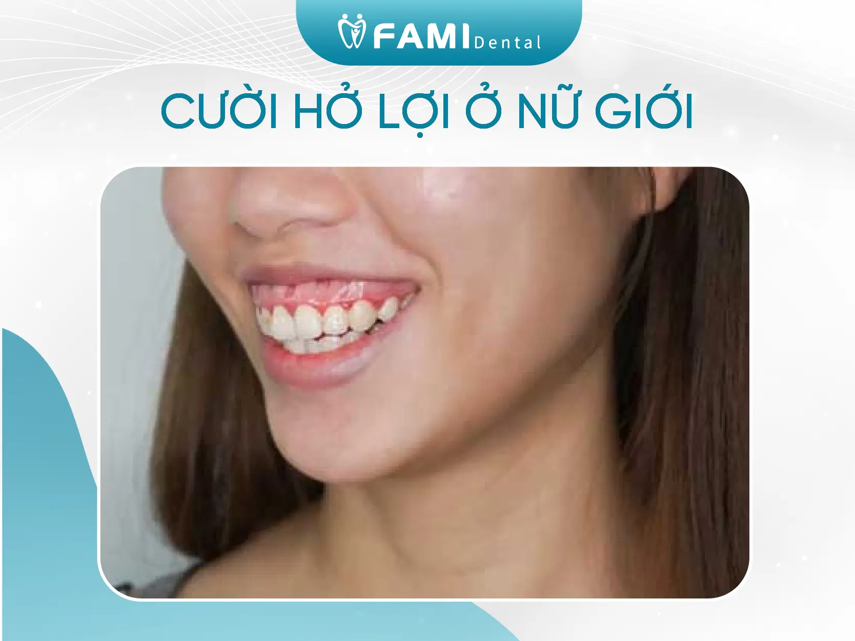 cười hở lợi ở nữ giới