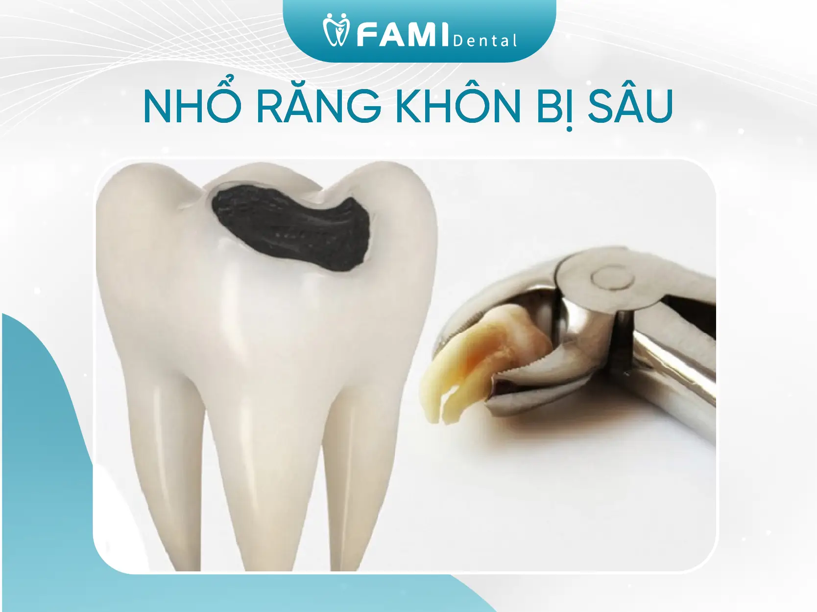 nhổ răng khôn bị sâu