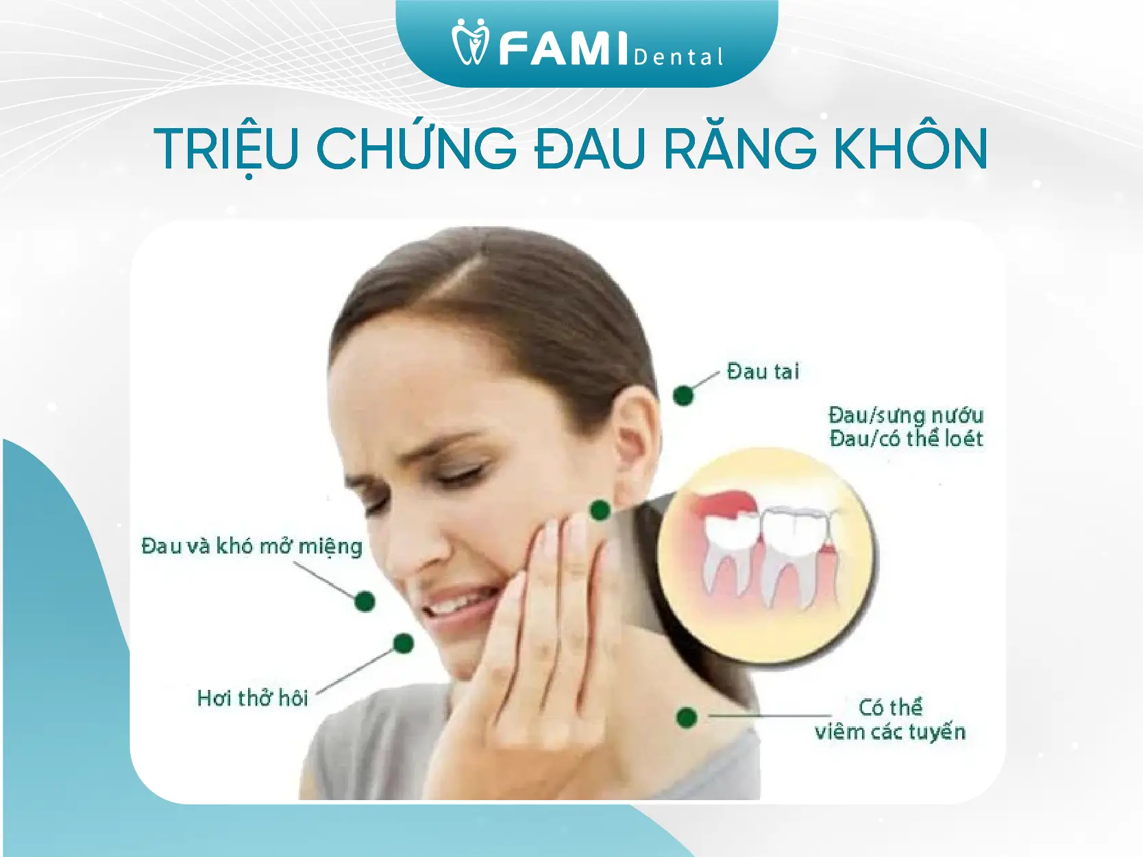 triệu chứng đau răng khôn mọc lệch