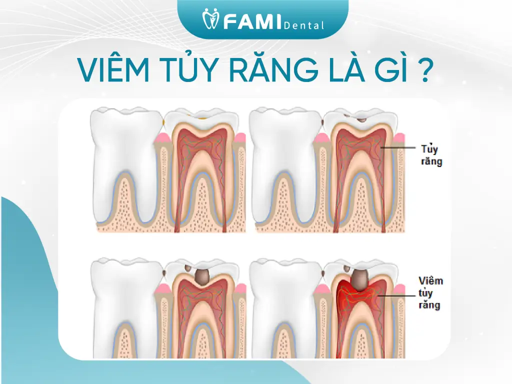 viêm tủy răng là gì