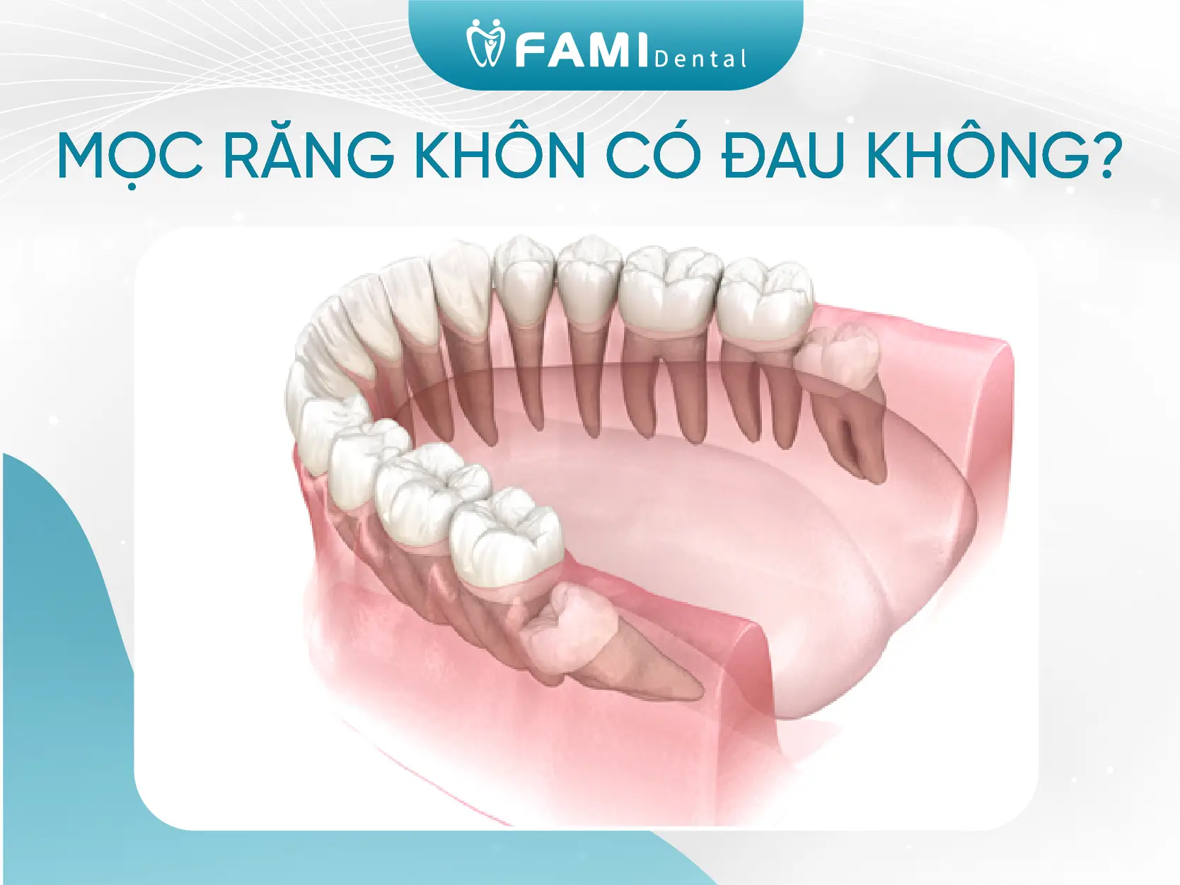 Mọc Răng Khôn Hàm Trên và Hàm Dưới Nên Làm Gì? 1 Mọc răng khôn có đau không