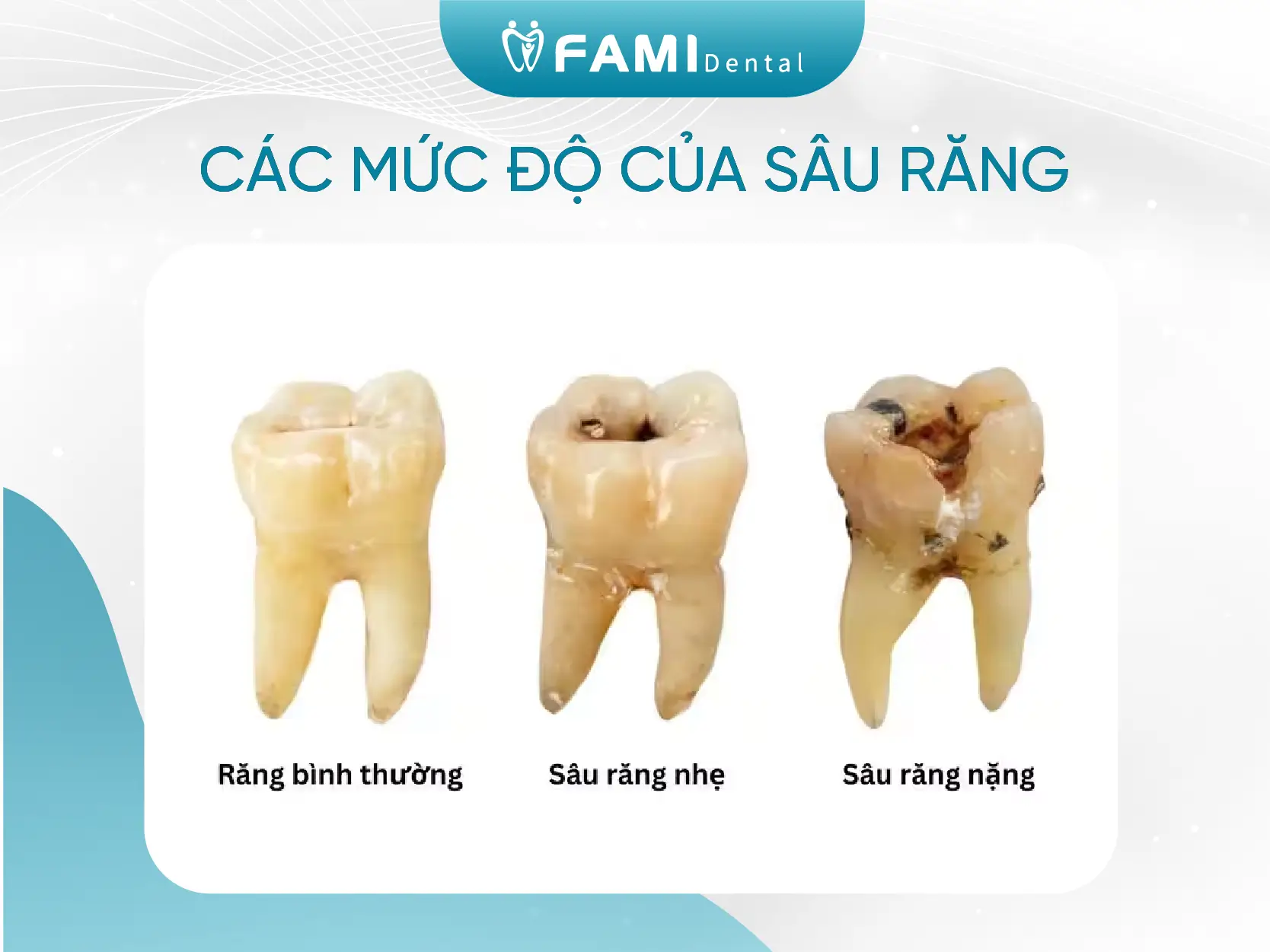 các mức độ của sâu răng