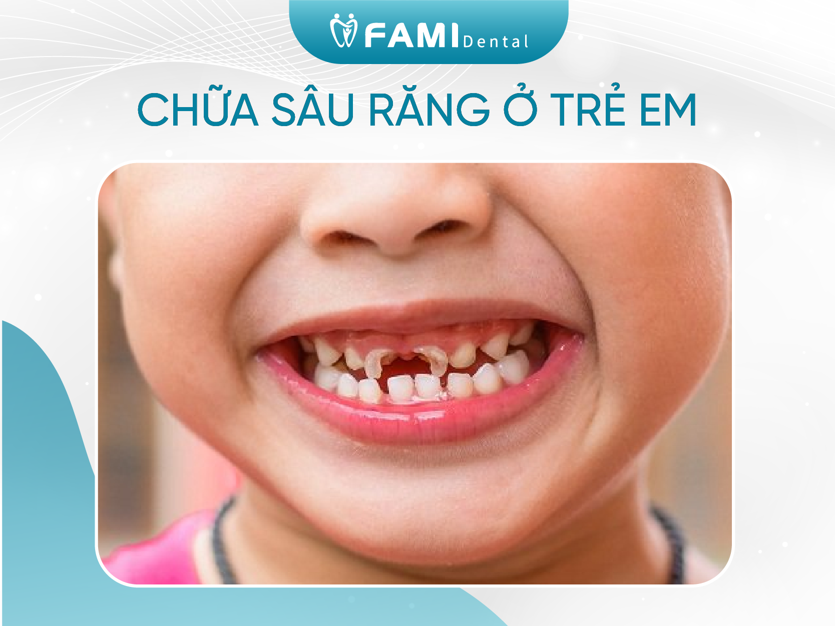 Chữa sâu răng ở trẻ em như thế nào?
