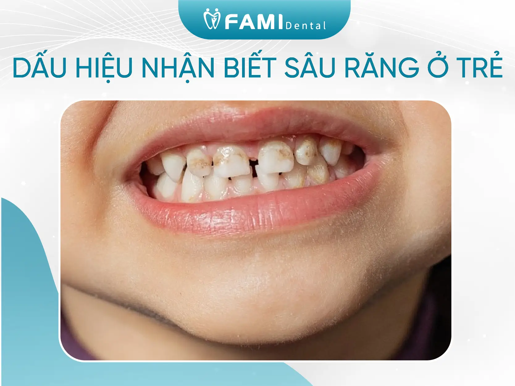 dấu hiệu nhận biết sâu răng ở trẻ em