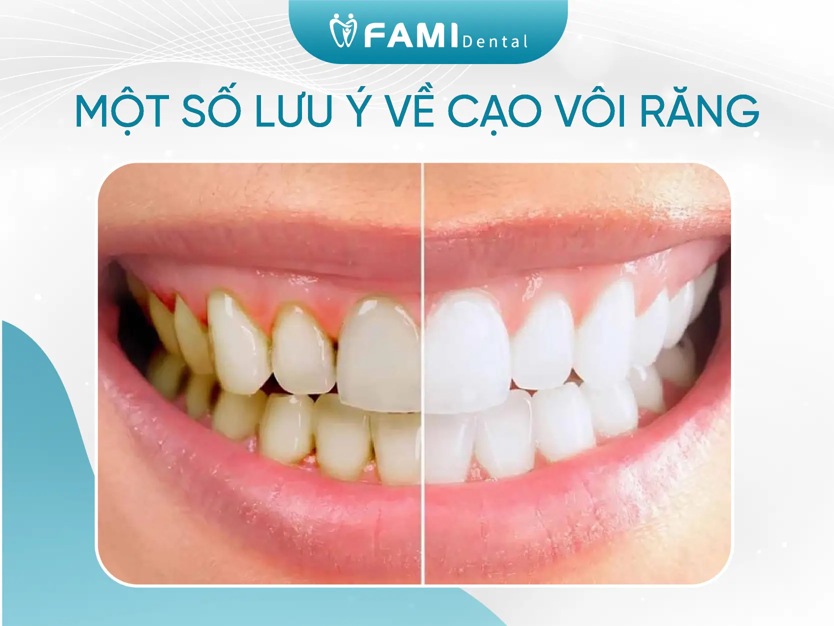 lưu ý về cạo vôi răng