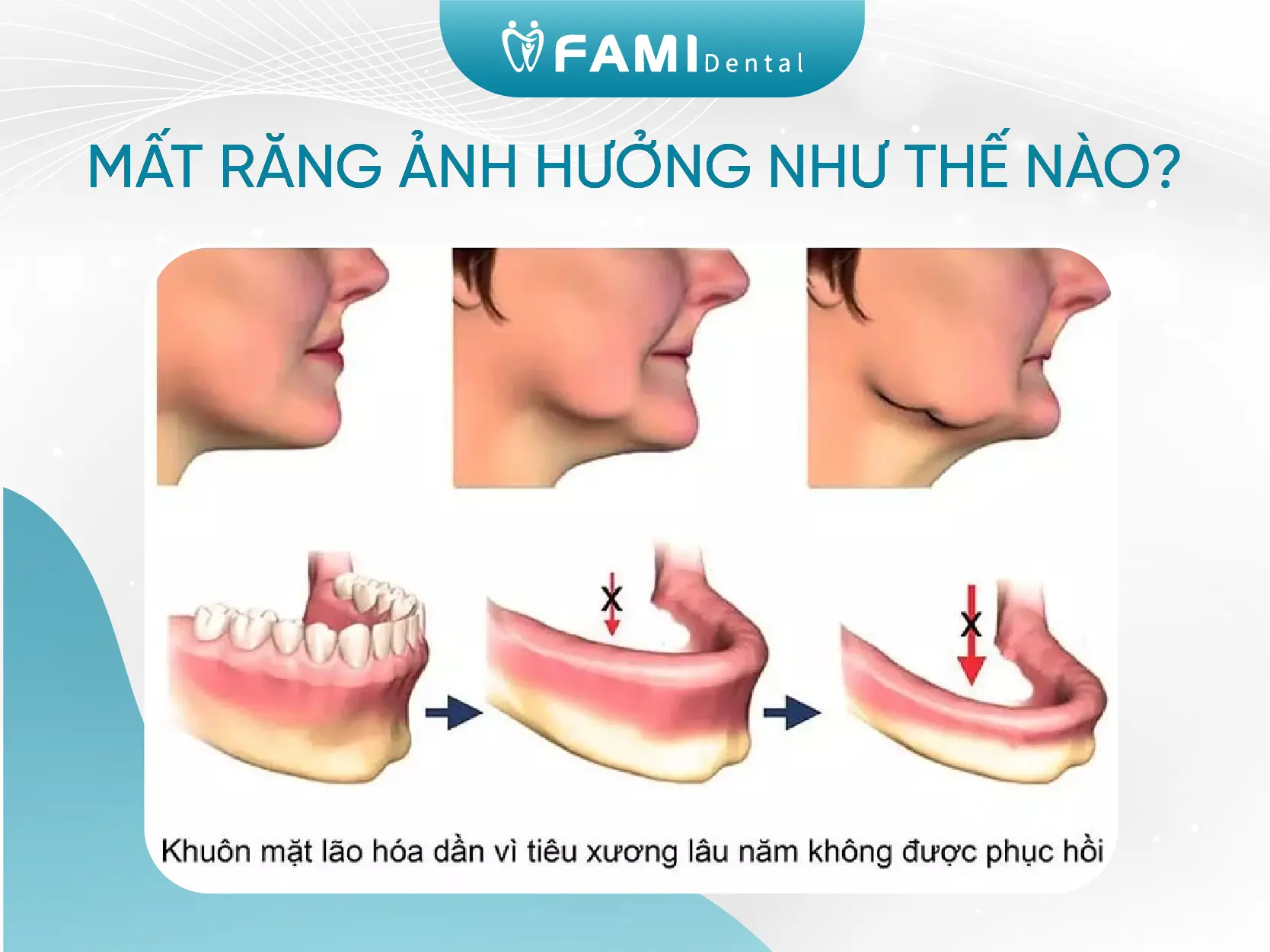 Nhổ răng xong nên kiêng ăn gì? 2 mất răng sau khi nhổ răng