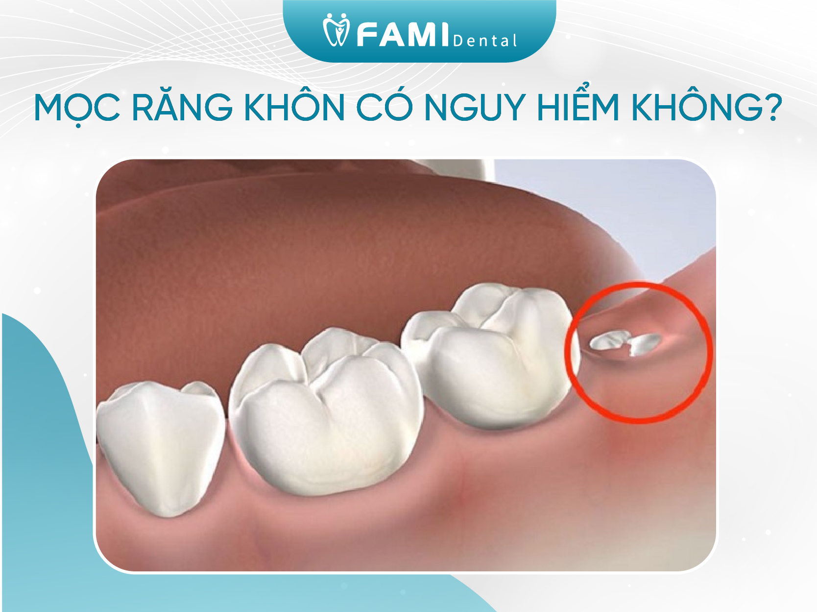 Mọc Răng Khôn Hàm Trên và Hàm Dưới Nên Làm Gì?