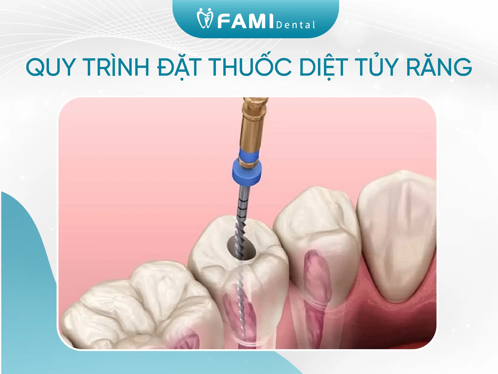 Khi nào thì sử dụng thuốc diệt tủy răng? 2 Quy trình đặt thuốc diệt tủy