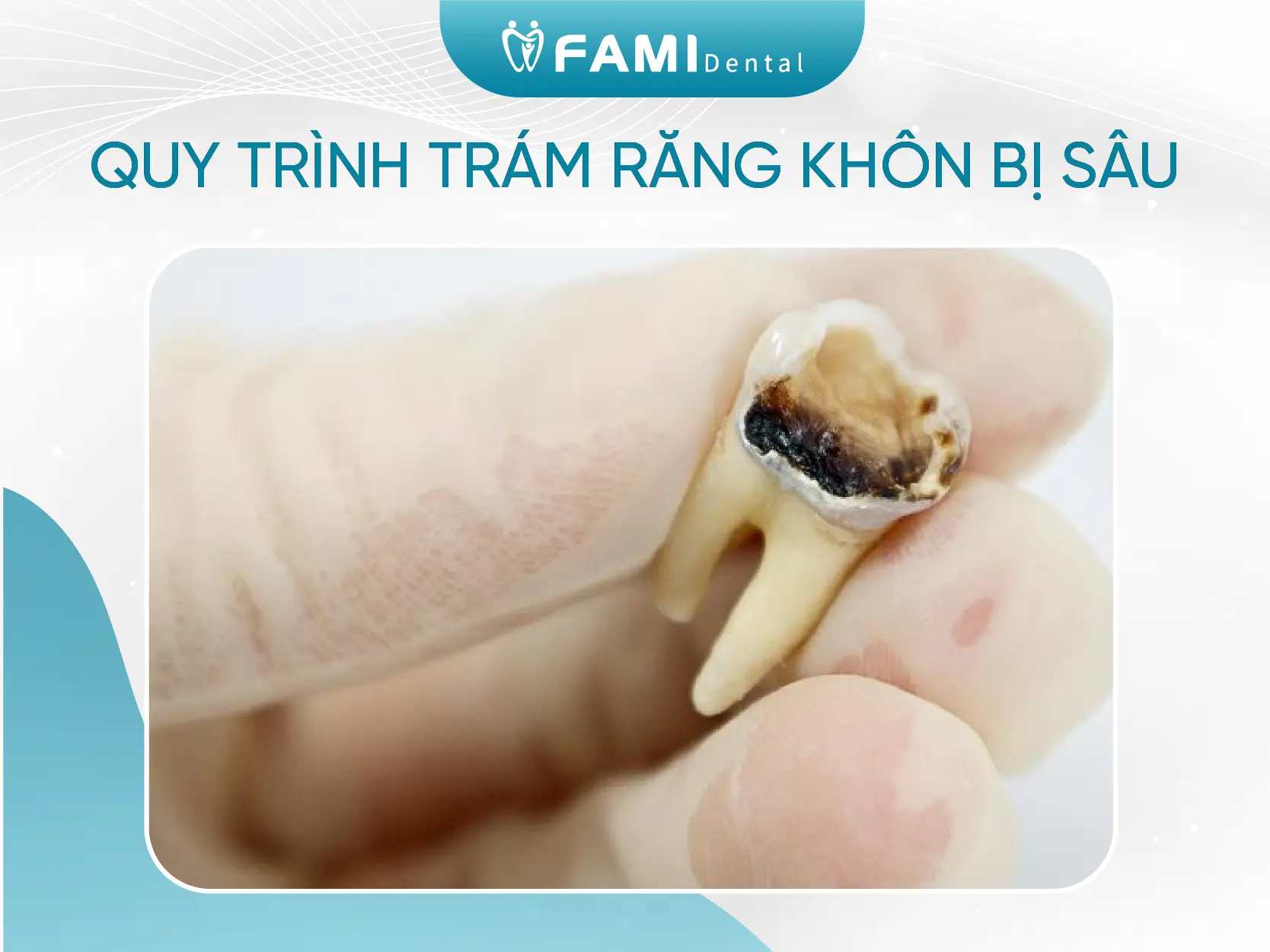 Có nên trám răng khôn hay không? Cập nhật mới nhất 2025 1 quy trình trám răng khôn