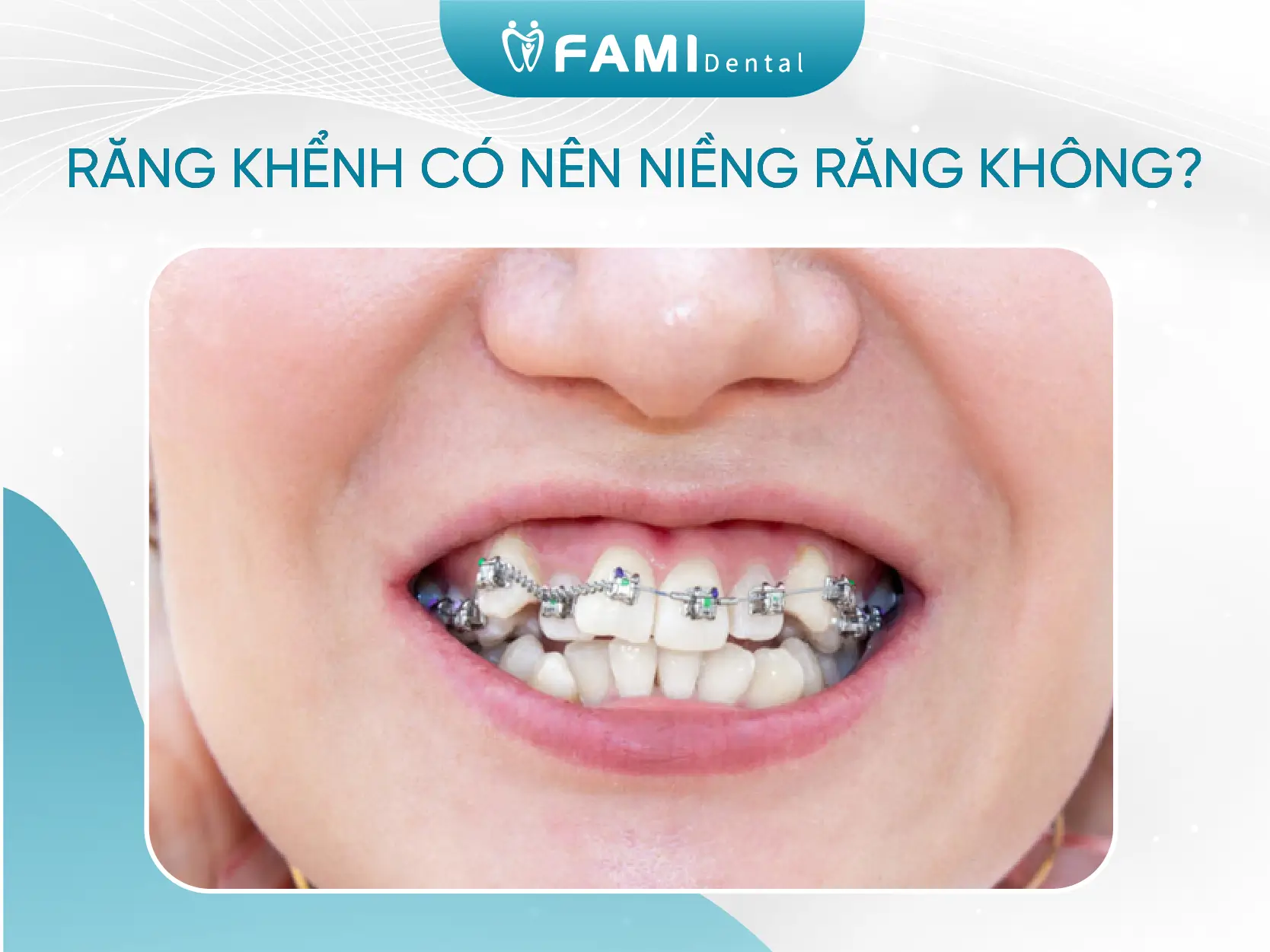 Răng khểnh ảnh hưởng như thế nào đến tướng số và phong thủy? 2 răng khểnh có nên niềng không