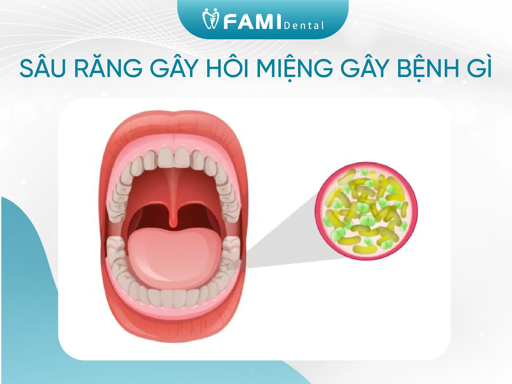 Sâu răng gây hôi miệng và 4 cách điều trị đơn giản nhất 1 sâu răng gây hôi miệng gây bệnh gì
