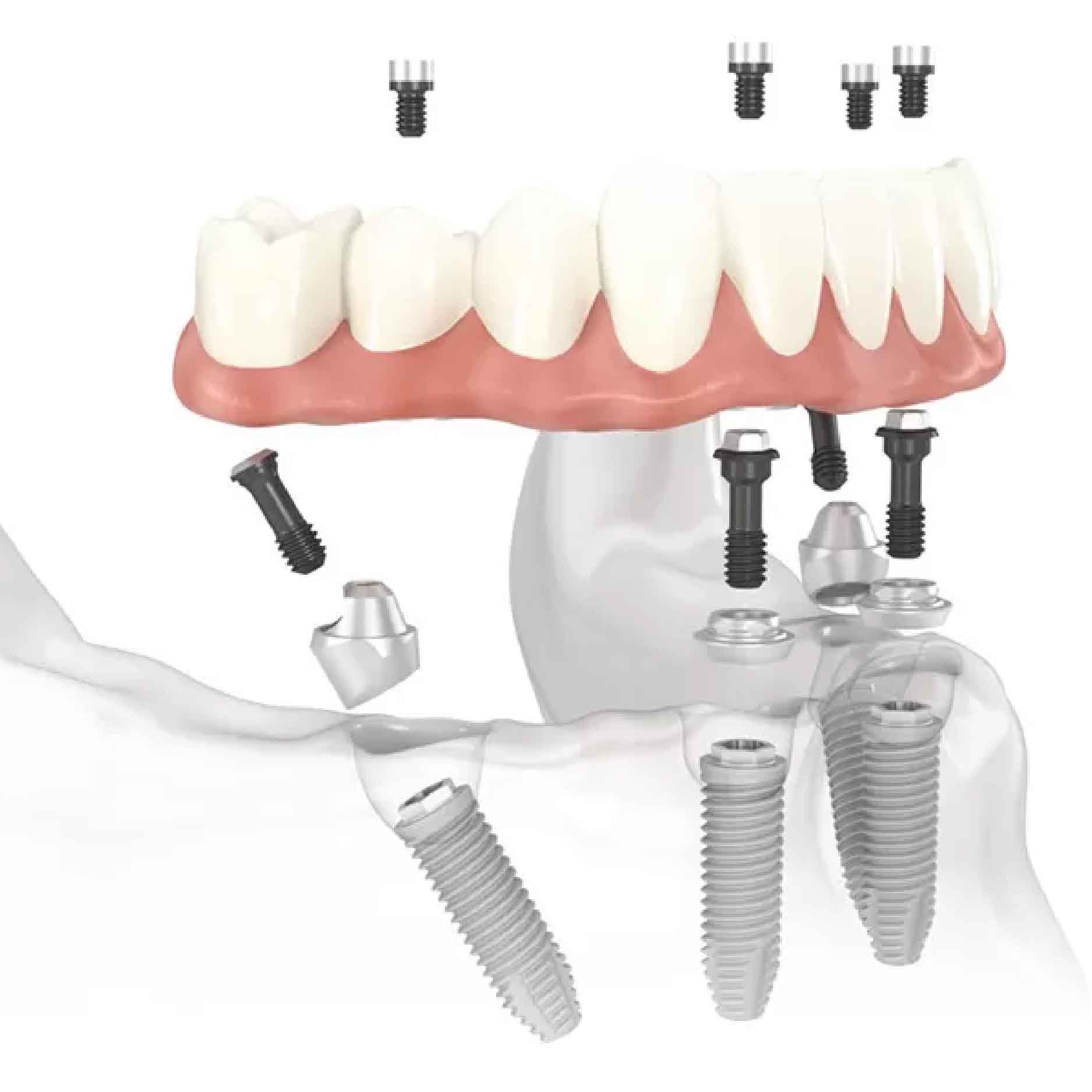 bien-chung-trong-rang-implant-toan-ham-01 bien chung trong rang implant toan ham 01