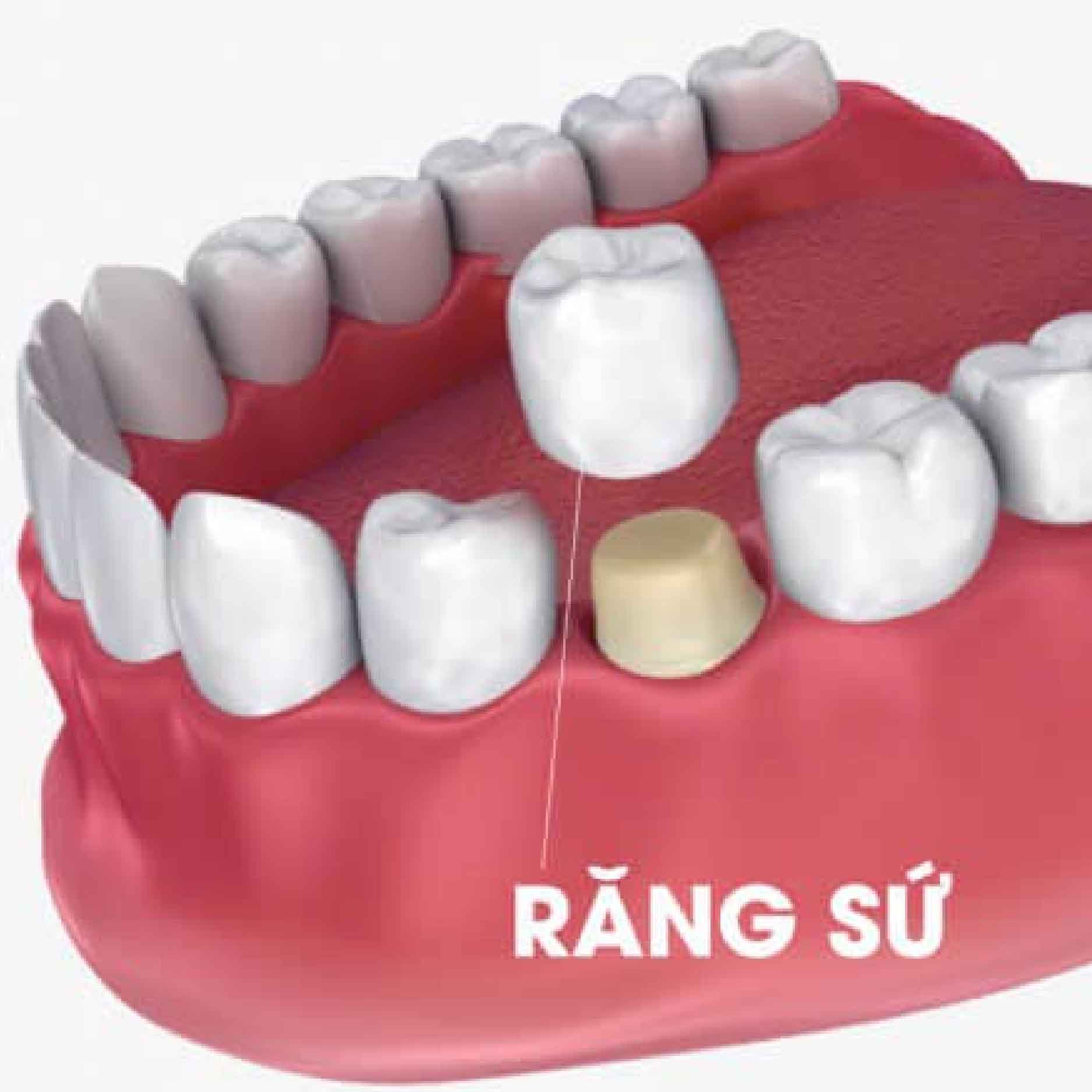 boc su cho rang dieu tri tuy 01
