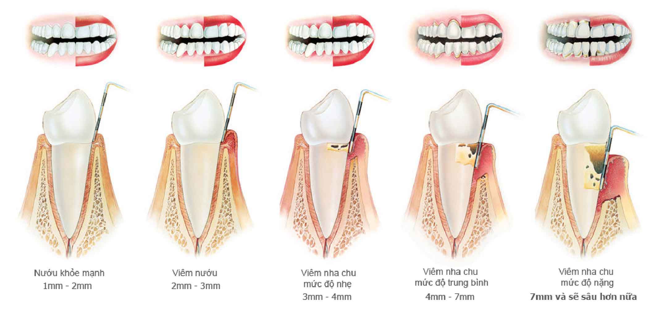 cac giai doan cua viem nha chu 03