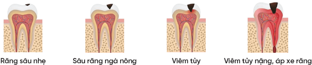 các mức độ sâu răng đến viêm tủy răng