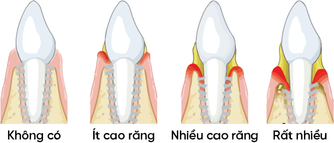 cấp độ của cao răng (vôi răng)