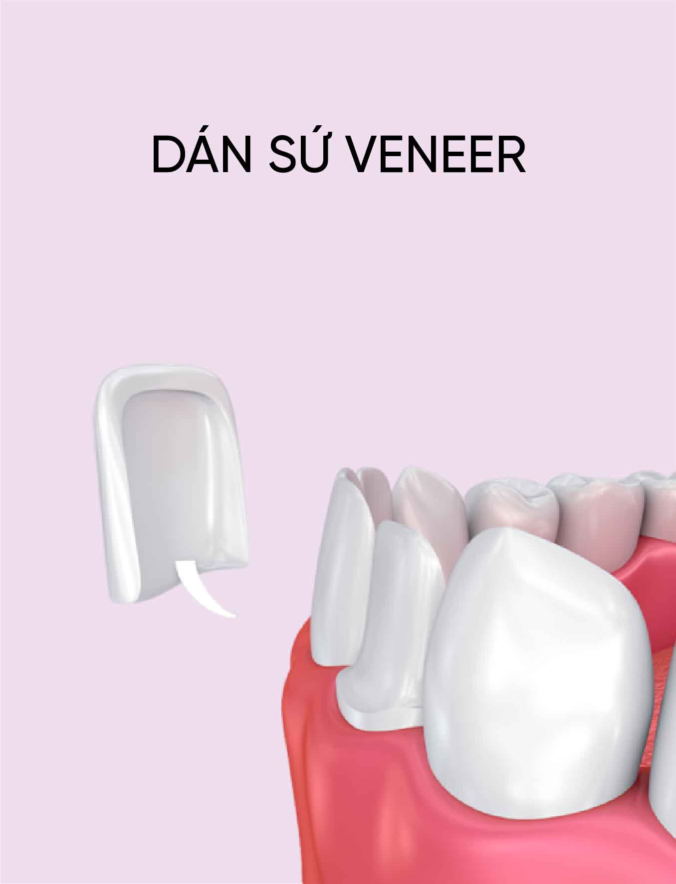 dich vu dan su veneer