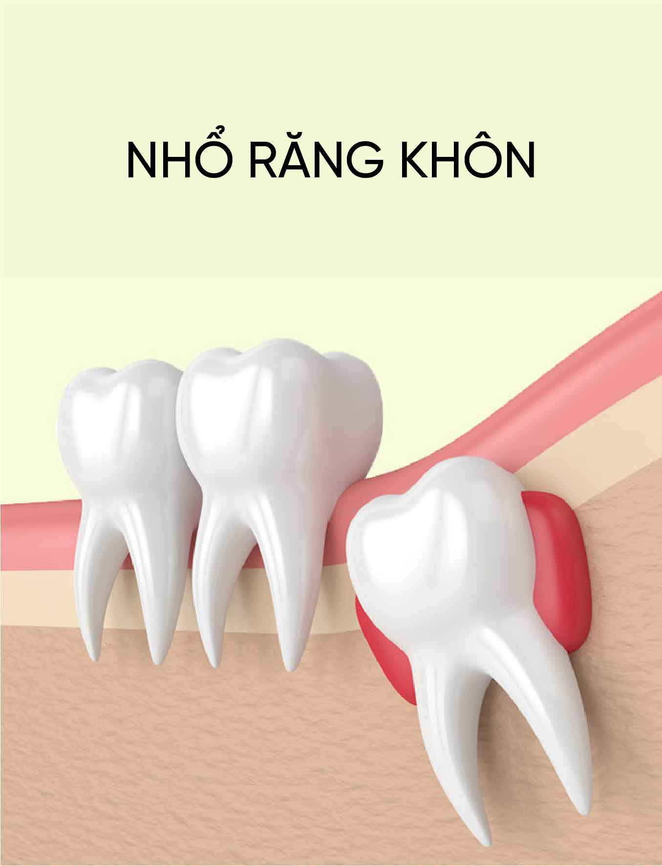 dich vu nho rang khon