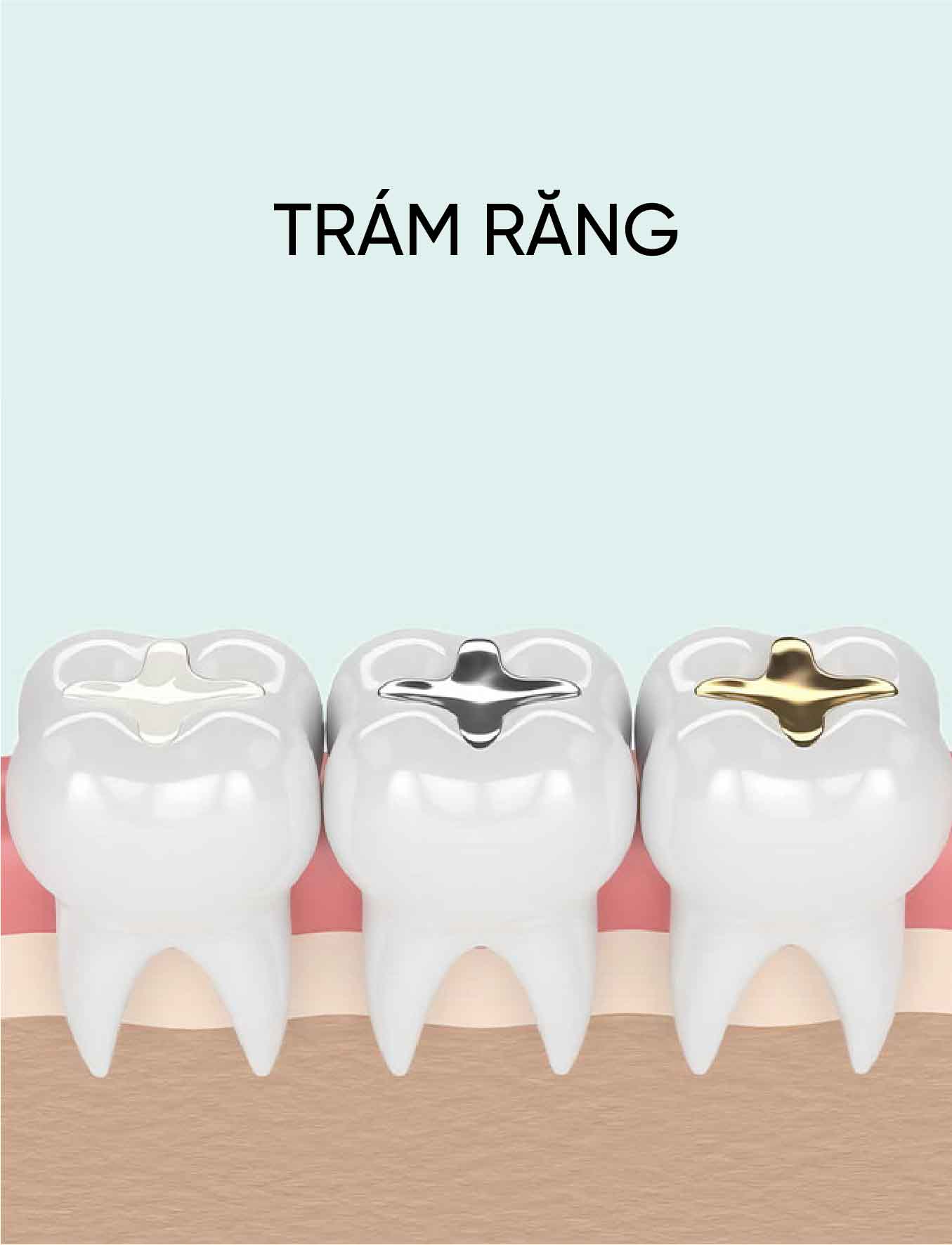 dich vu tram rang