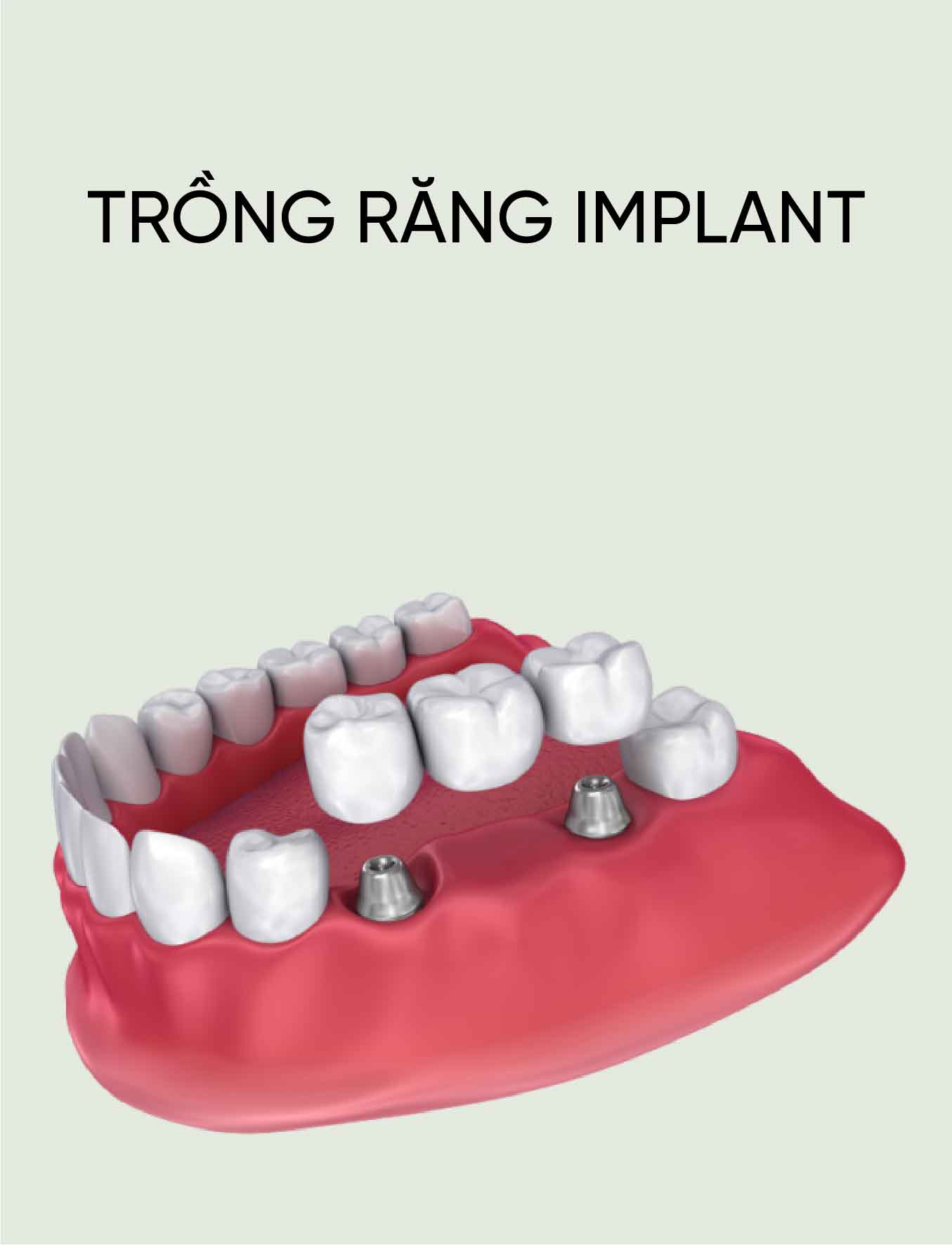 dich vu trong rang implant