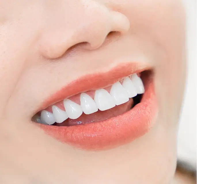 khách hàng dán sứ emax