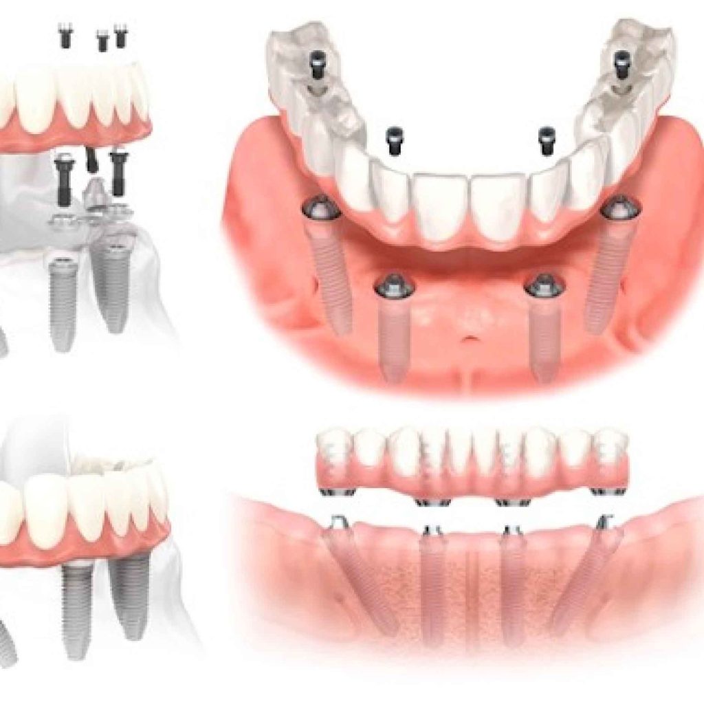 phuc-hinh-implant-toan-ham-01 phuc hinh implant toan ham 01
