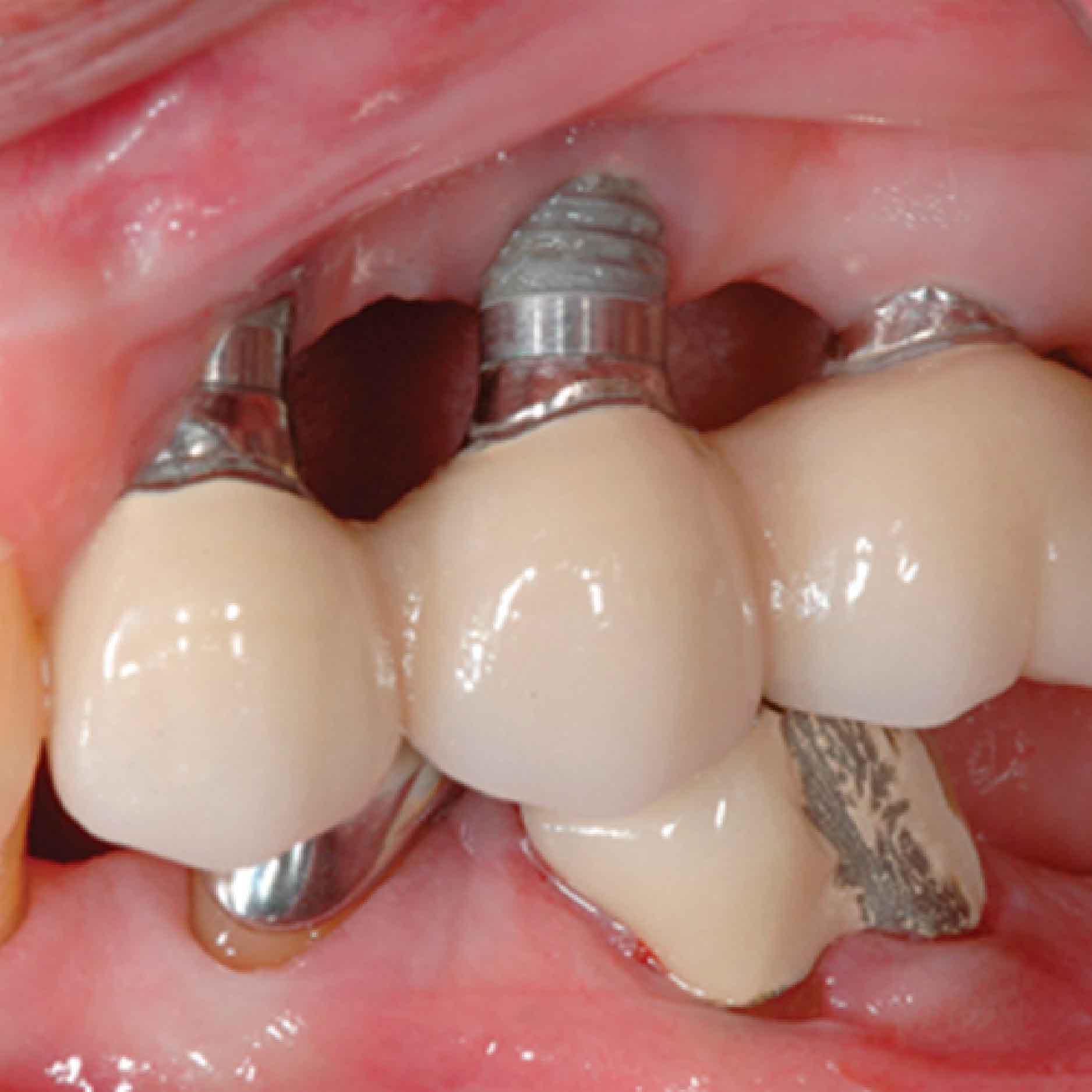rui-ro-khi-trong-rang-implant-01 rui ro khi trong rang implant 01