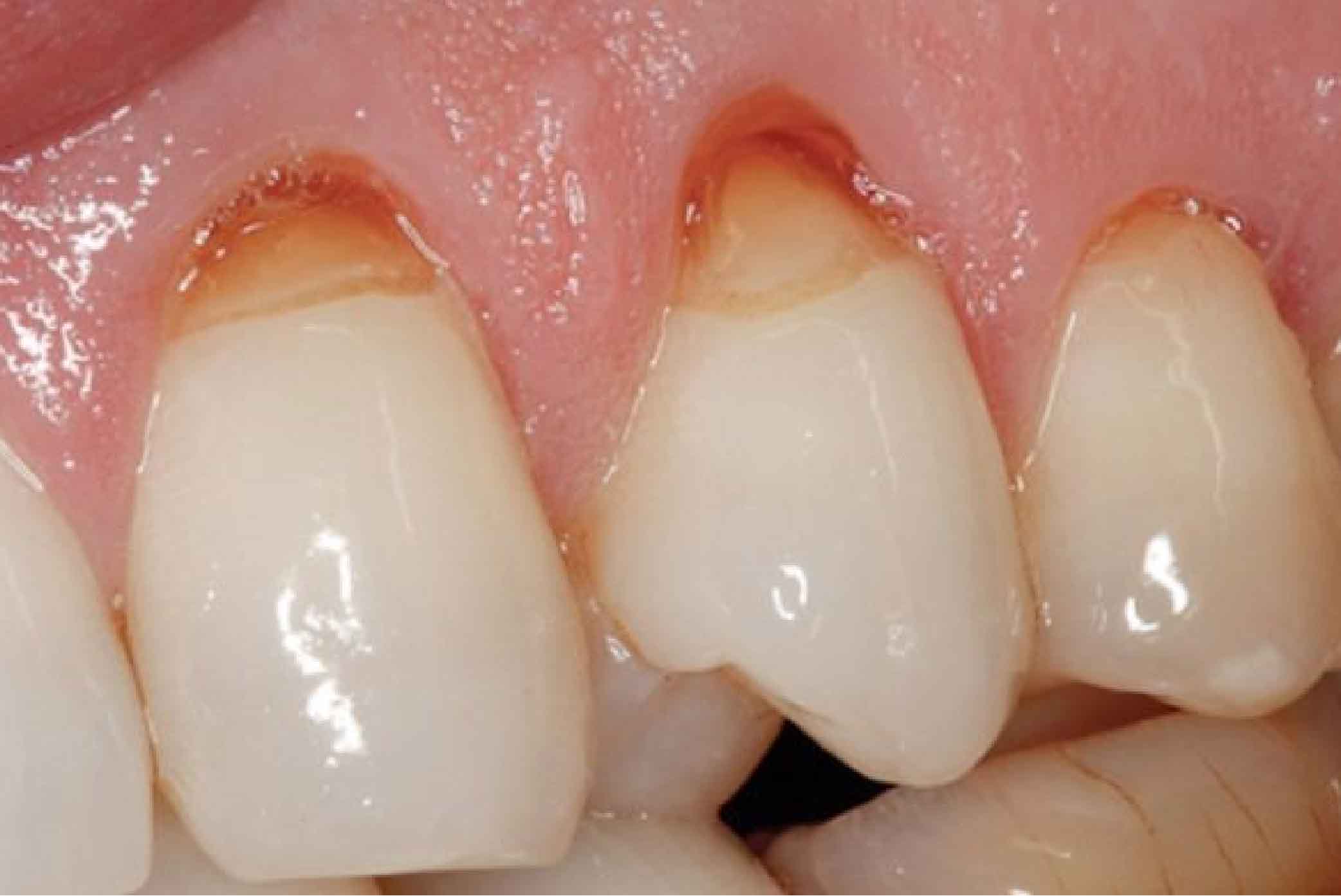 trám mòn cổ răng, làm dài thân răng