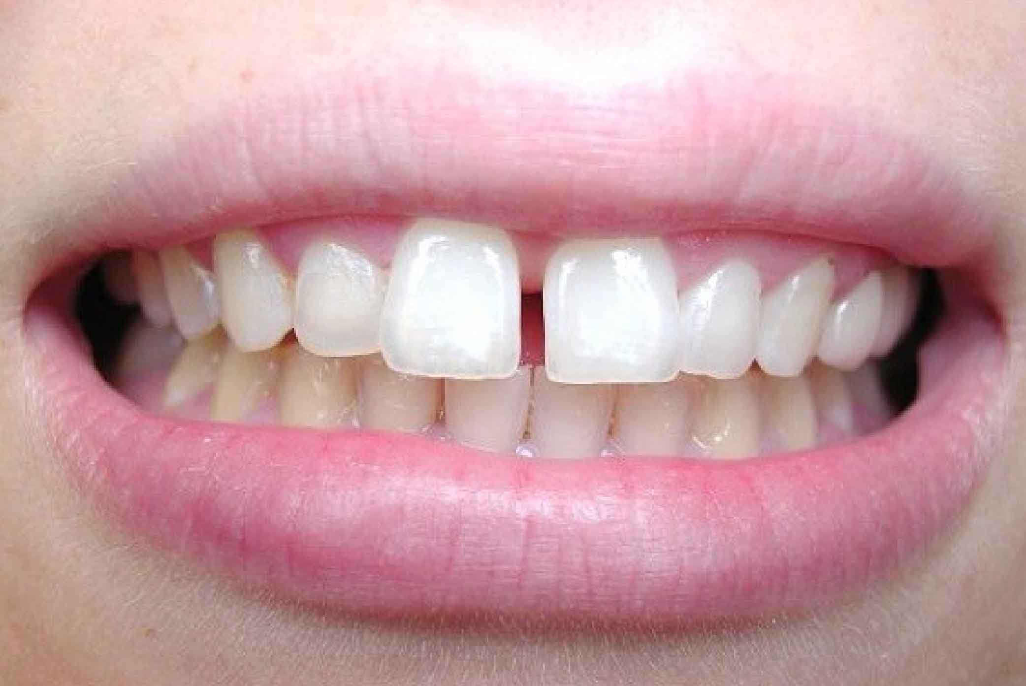 trám thưa răng cửa