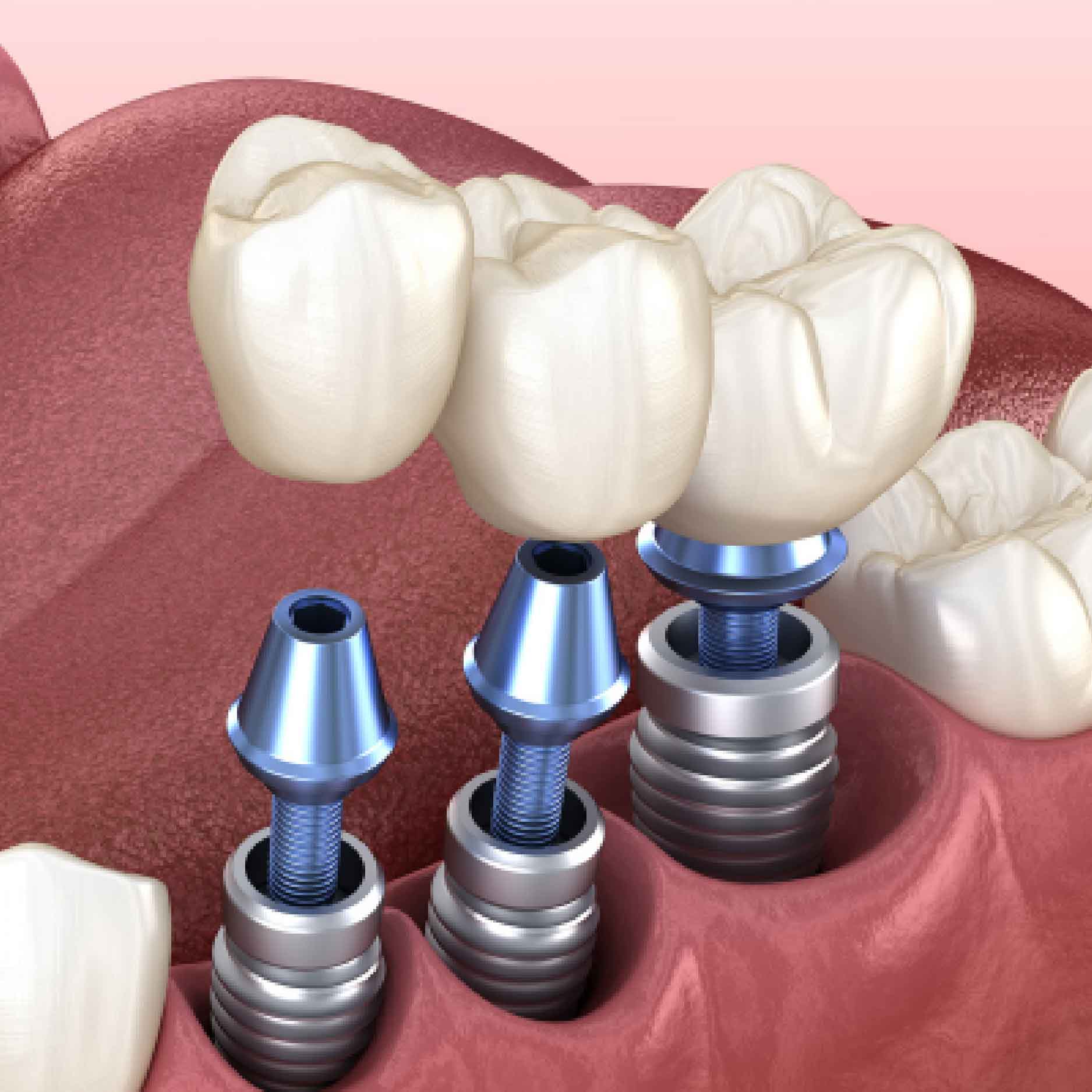 trong-rang-implant-don-le-01 trong rang implant don le 01