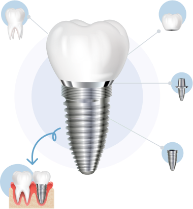 trong-rang-implant-la-gi trong rang implant la gi