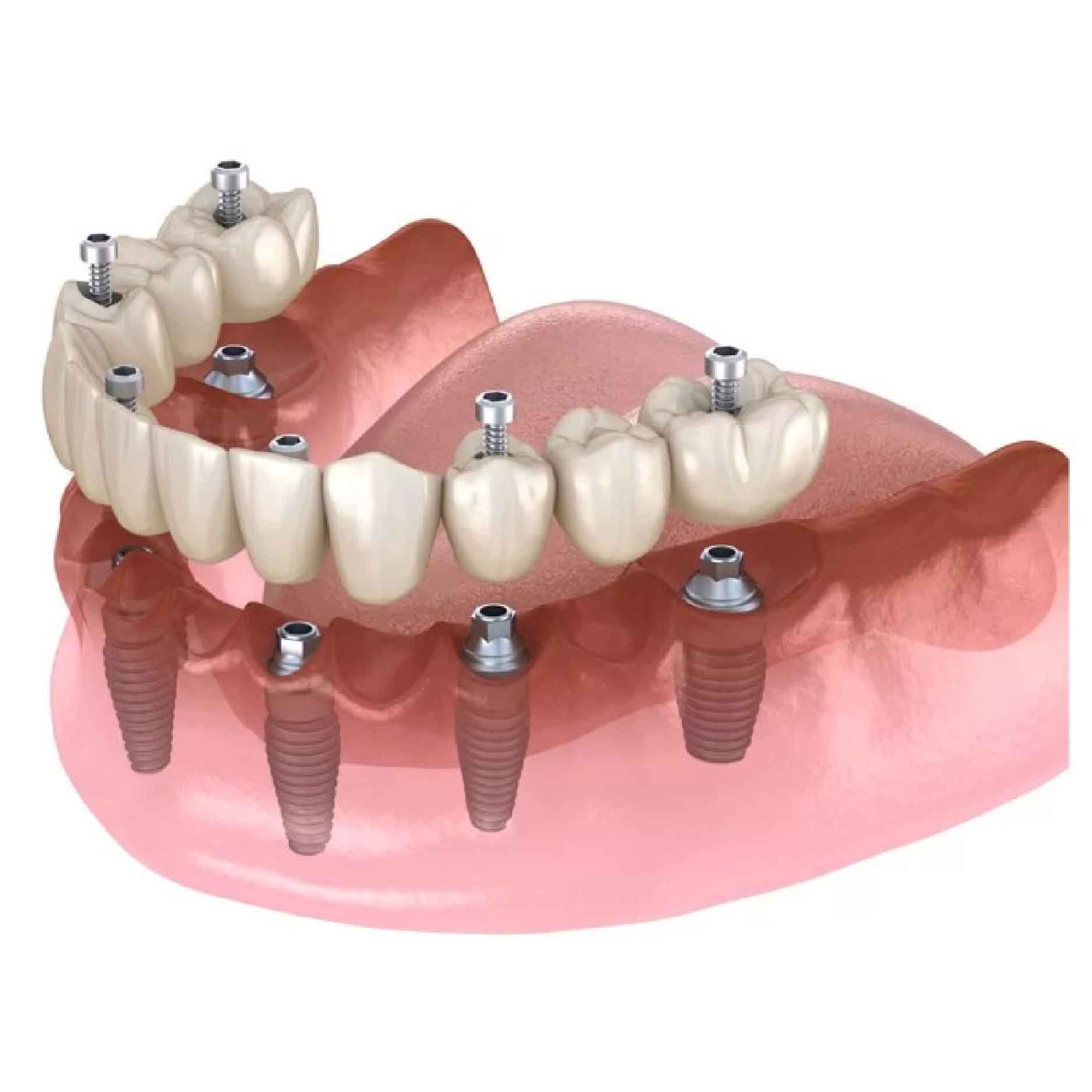 trong-rang-implant-toan-ham-01 trong rang implant toan ham 01