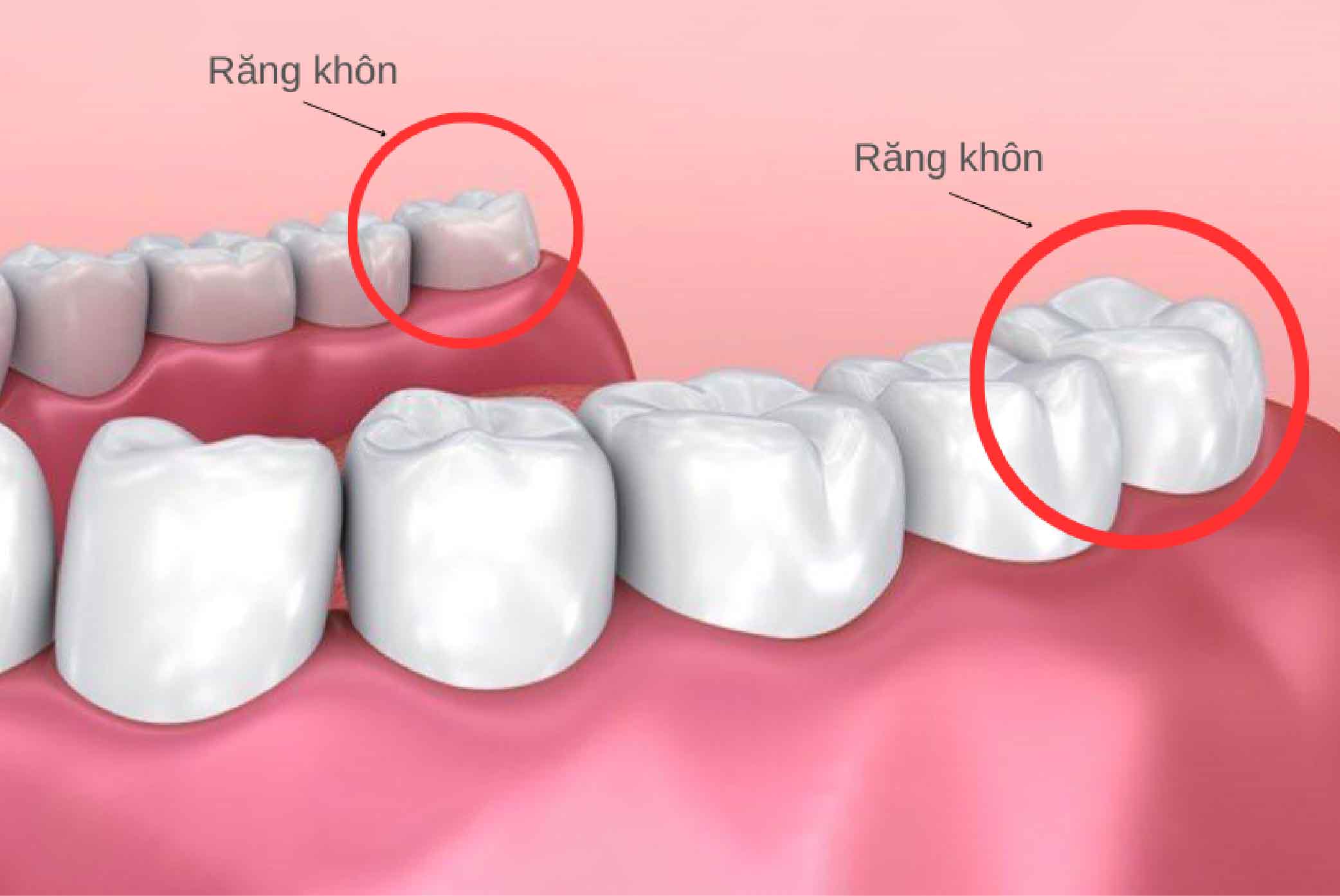 truong hop khong can nho rang khon 02