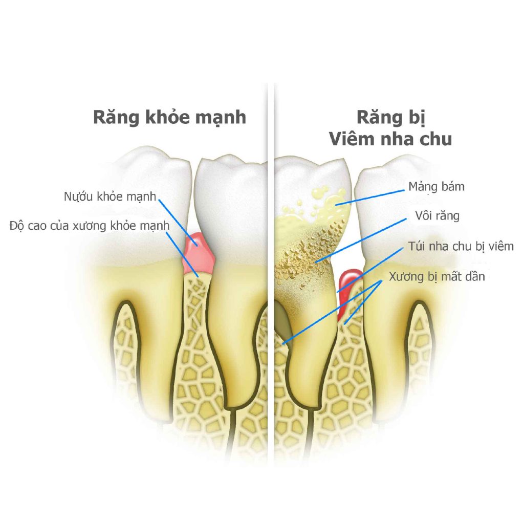 viem nha chu la gi 01